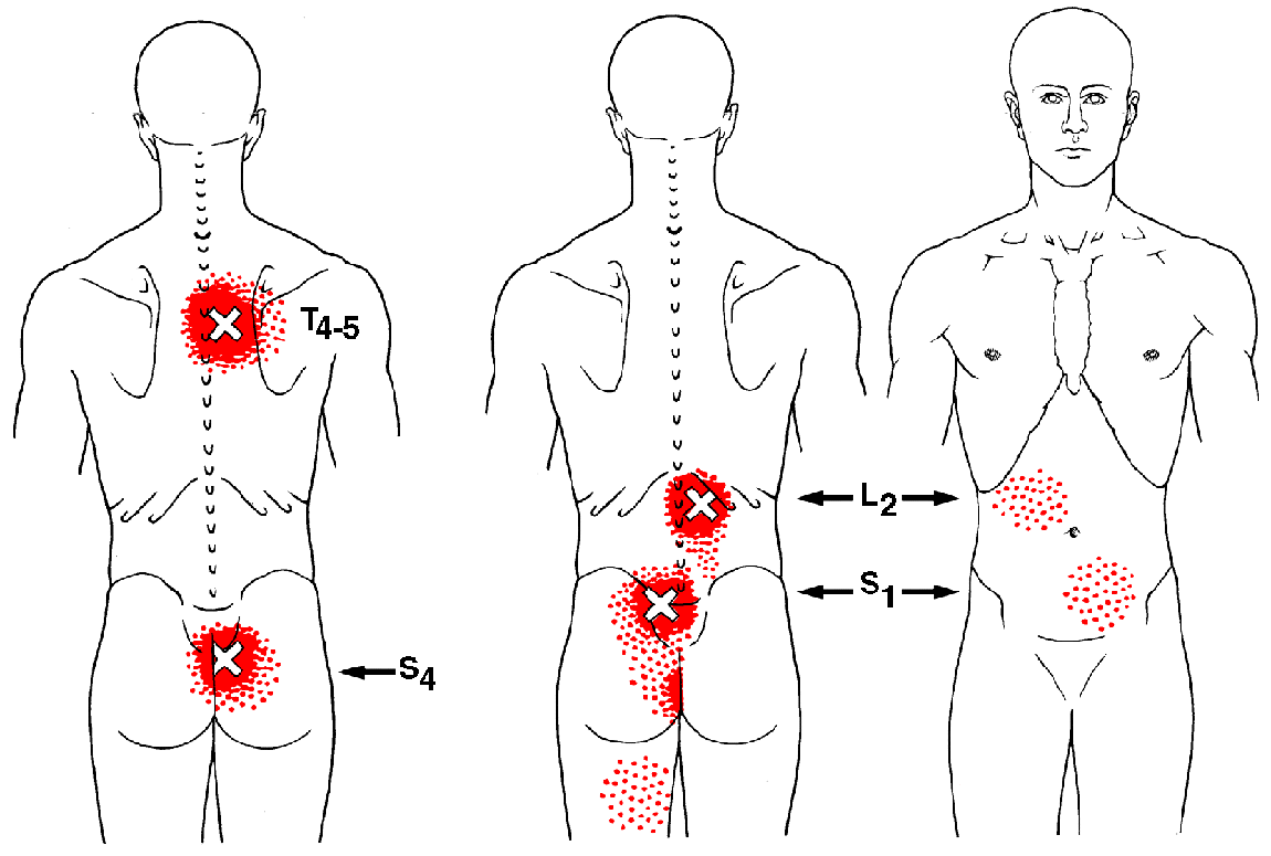 Multifidi The Trigger Point And Referred Pain Guide